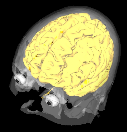 brainweb image segmented